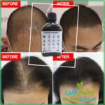 محلول گیاهی ضدریزش مو هیرپاور Hair Power حکیم لاین