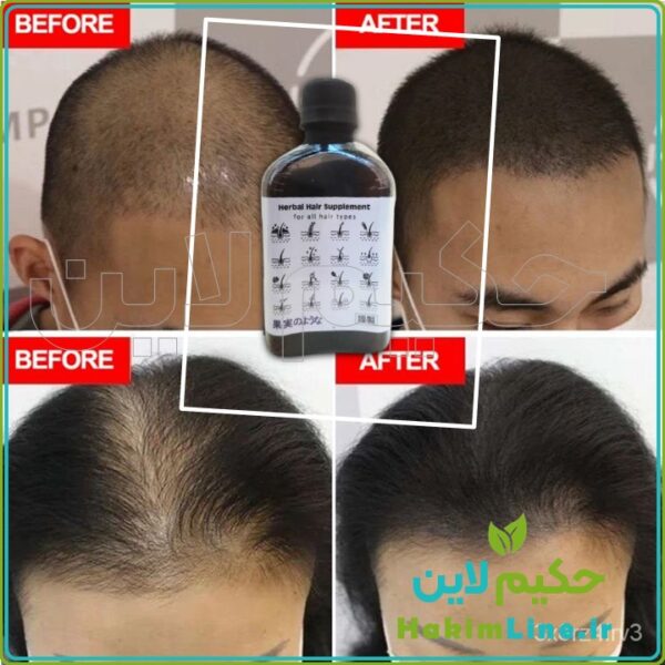 محلول گیاهی ضدریزش مو هیرپاور Hair Power حکیم لاین