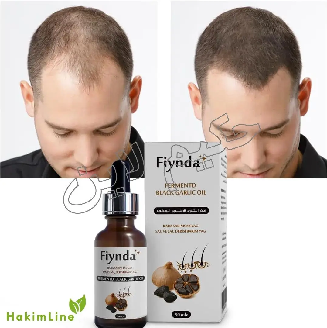 سرم سیر سیاه اصل فرانسه – راهکاری انقلابی برای جلوگیری از ریزش و افزایش رویش مو (100% علمی)