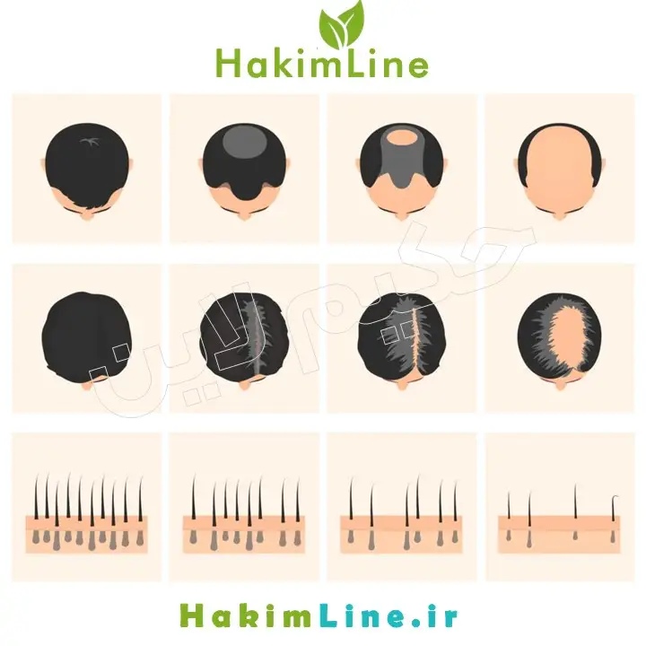 تاثیر هورمون DHT بر ریزش مو (بررسی علمی)